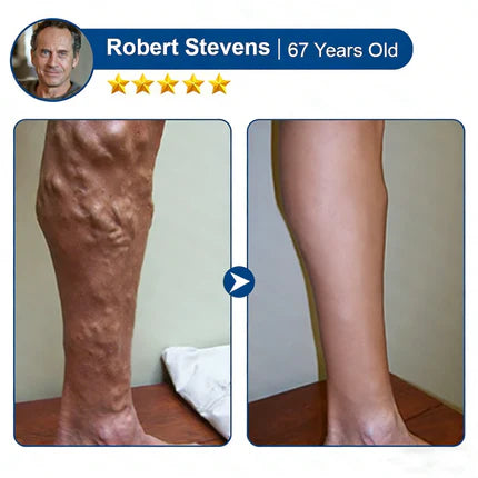 šØāāļøš„ Vein Target Microneedle Care Patchā”Instant Relief, Long-Term Results-8JX3