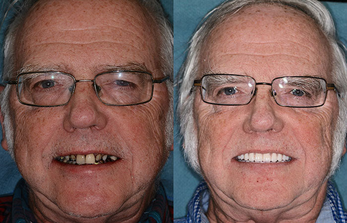 ⏰Ends Today: 70% OFF 🦷 Get Your Smile Back Without Expensive Dental Visits Custom-Fit Comfort Dentures-8RH7