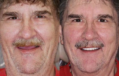 ⏰Ends Today: 70% OFF 🦷 Get Your Smile Back Without Expensive Dental Visits Custom-Fit Comfort Dentures-8RH7