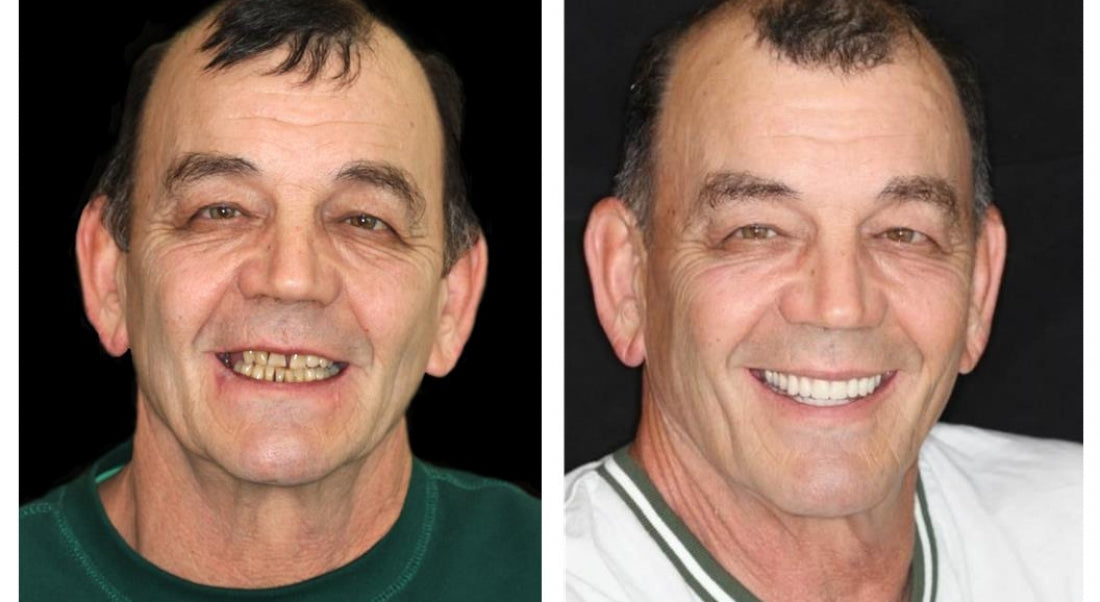 ⏰Ends Today: 70% OFF 🦷 Get Your Smile Back Without Expensive Dental Visits Custom-Fit Comfort Dentures-8RH7