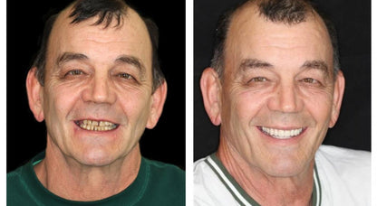 ⏰Ends Today: 70% OFF 🦷 Get Your Smile Back Without Expensive Dental Visits Custom-Fit Comfort Dentures-8RH7