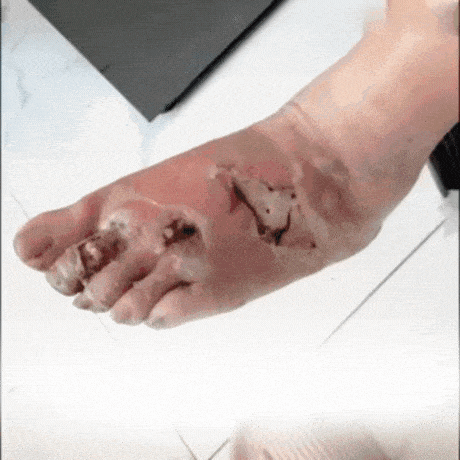 🩺No more pain from diabetic wounds immediately!🧪VitaGluco Diabetes Treatment Cream✨-8HJ9