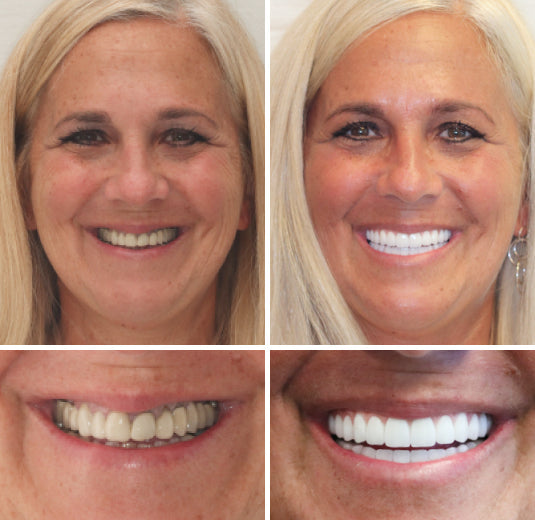⏰Ends Today: 70% OFF 🦷 Get Your Smile Back Without Expensive Dental Visits Custom-Fit Comfort Dentures-8RH7
