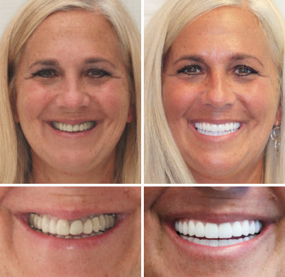⏰Ends Today: 70% OFF 🦷 Get Your Smile Back Without Expensive Dental Visits Custom-Fit Comfort Dentures-8RH7