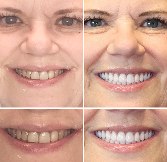 ⏰Ends Today: 70% OFF 🦷 Get Your Smile Back Without Expensive Dental Visits Custom-Fit Comfort Dentures-8RH7