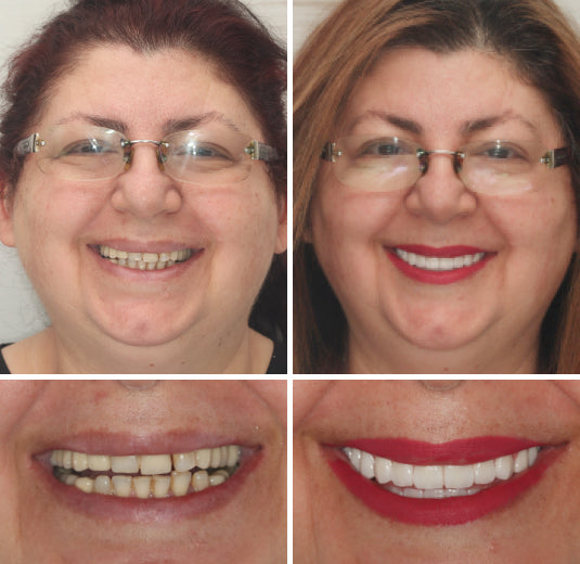 ⏰Ends Today: 70% OFF 🦷 Get Your Smile Back Without Expensive Dental Visits Custom-Fit Comfort Dentures-8RH7