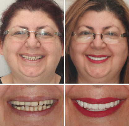 ⏰Ends Today: 70% OFF 🦷 Get Your Smile Back Without Expensive Dental Visits Custom-Fit Comfort Dentures-8RH7