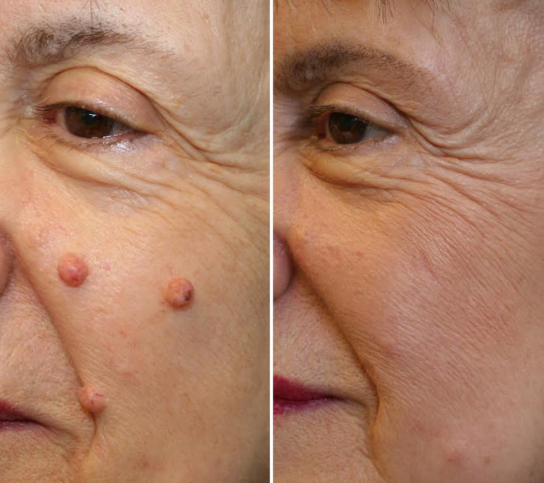 🏆 #1 Dermatologist-Recommended Cryo Renewal Spray🥼| Removes warts and skin tags efficiently while promoting your skin’s natural recovery🧪-8HJ9