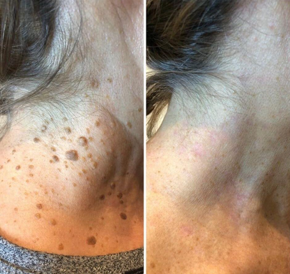 🏆 #1 Dermatologist-Recommended Cryo Renewal Spray🥼| Removes warts and skin tags efficiently while promoting your skin’s natural recovery🧪-8HJ9