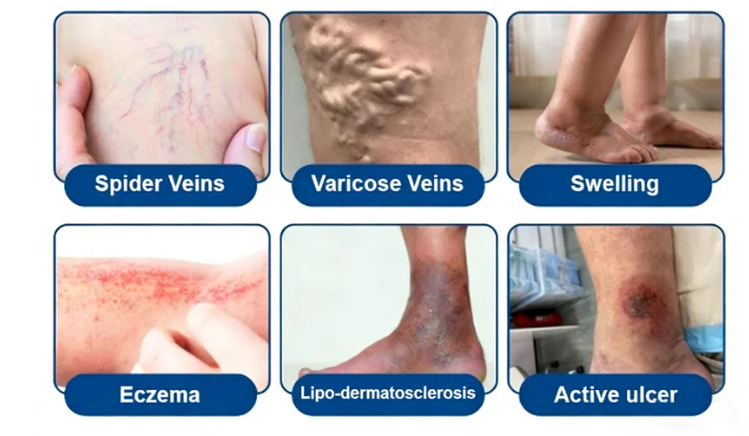 👨‍⚕️🔥 Vein Target Microneedle Care Patch⚡Instant Relief, Long-Term Results-8JX3