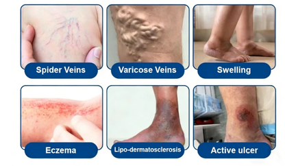 👨‍⚕️🔥 Vein Target Microneedle Care Patch⚡Instant Relief, Long-Term Results-8JX3