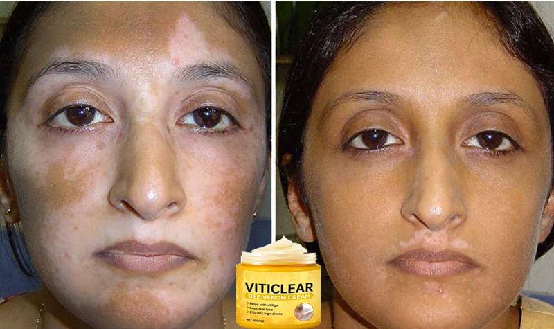 🐝🔥 BEST SELLER 50% OFF ✨ VitiClear Bee Venom Cream Ultra–Improve Skin Pigmentation, Natural Formula, Suitable for All Skin-8YF7