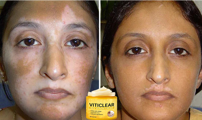 🐝🔥 BEST SELLER 50% OFF ✨ VitiClear Bee Venom Cream Ultra–Improve Skin Pigmentation, Natural Formula, Suitable for All Skin-8YF7
