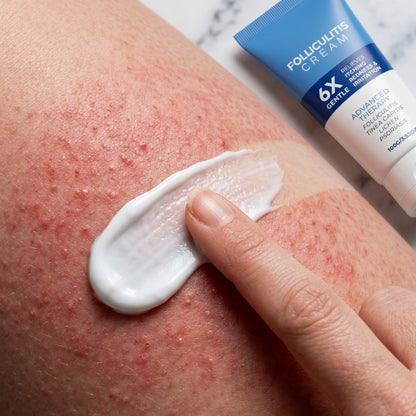 🌟【Top Choice|Over 10k+ Sold🥇】Folliculitis Soothing Cream - Organic Gentle Botanical Formula for Scalp Face & Body Advanced Formula-8SA8