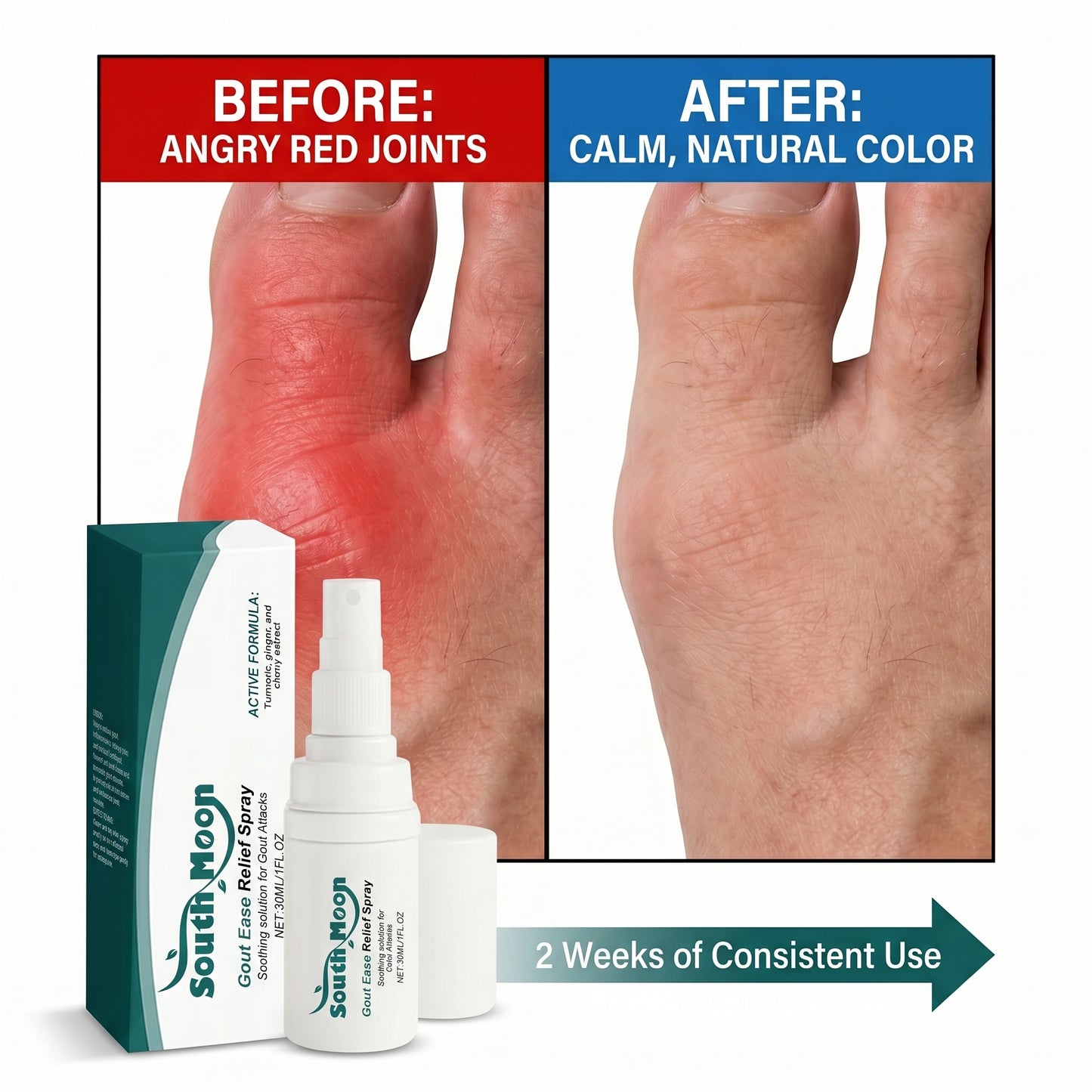🔥Hot  | 30k+ Sold✅【GoutEase Relief Spray】Targeted relief from gout pain, penetrates deeply to calm inflammation, break down uric acid-8SA8