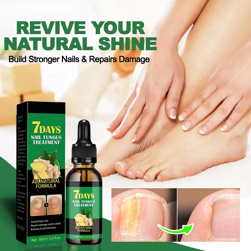 🌏Hot Selling Globally🥇🔥7 DAYS Nail Fungus Treatment, healthy and strong nails-8SA8