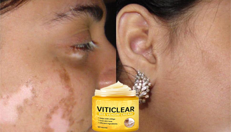 🐝🔥 BEST SELLER 50% OFF ✨ VitiClear Bee Venom Cream Ultra–Improve Skin Pigmentation, Natural Formula, Suitable for All Skin-8YF7