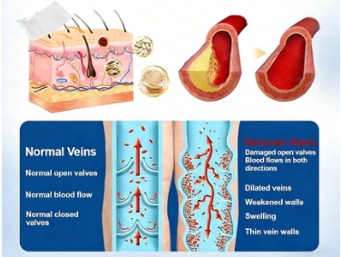👨‍⚕️🔥 Vein Target Microneedle Care Patch⚡Instant Relief, Long-Term Results-8JX3