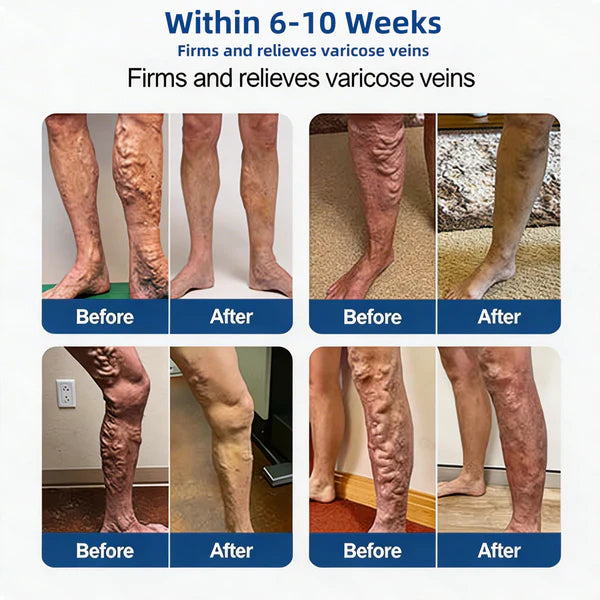 👨‍⚕️🔥 Vein Target Microneedle Care Patch⚡Instant Relief, Long-Term Results-8JX3
