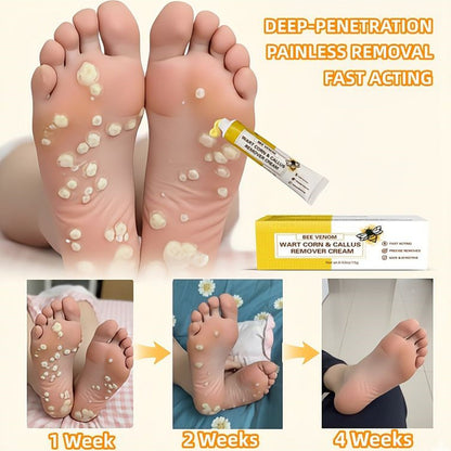 🔥LIMITED TIME DISCOUNT🔥 Sandal Confidence Again—Without Shame, Without Pain, Without Recurrence🤩|Bee Venom Wart Corn & Callus Remover Cream🐝-8HJ9