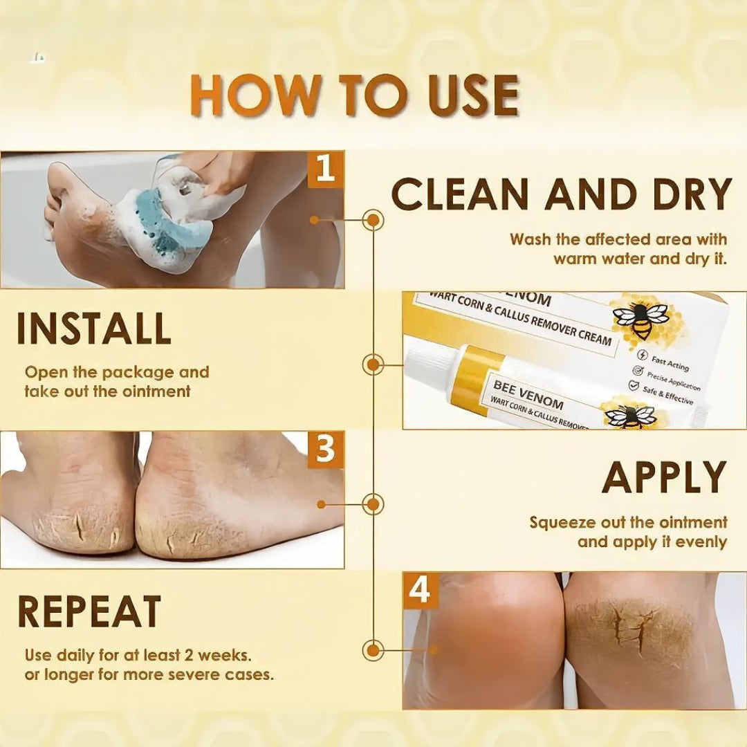 🔥LIMITED TIME DISCOUNT🔥 Sandal Confidence Again—Without Shame, Without Pain, Without Recurrence🤩|Bee Venom Wart Corn & Callus Remover Cream🐝-8HJ9