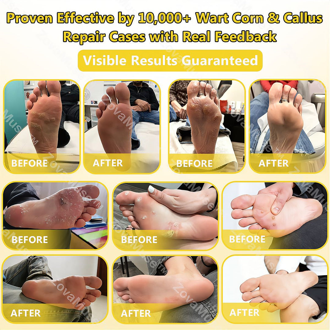 🔥LIMITED TIME DISCOUNT🔥 Sandal Confidence Again—Without Shame, Without Pain, Without Recurrence🤩|Bee Venom Wart Corn & Callus Remover Cream🐝-8HJ9