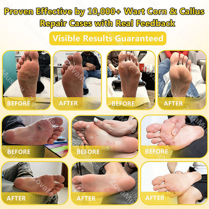 🔥LIMITED TIME DISCOUNT🔥 Sandal Confidence Again—Without Shame, Without Pain, Without Recurrence🤩|Bee Venom Wart Corn & Callus Remover Cream🐝-8HJ9