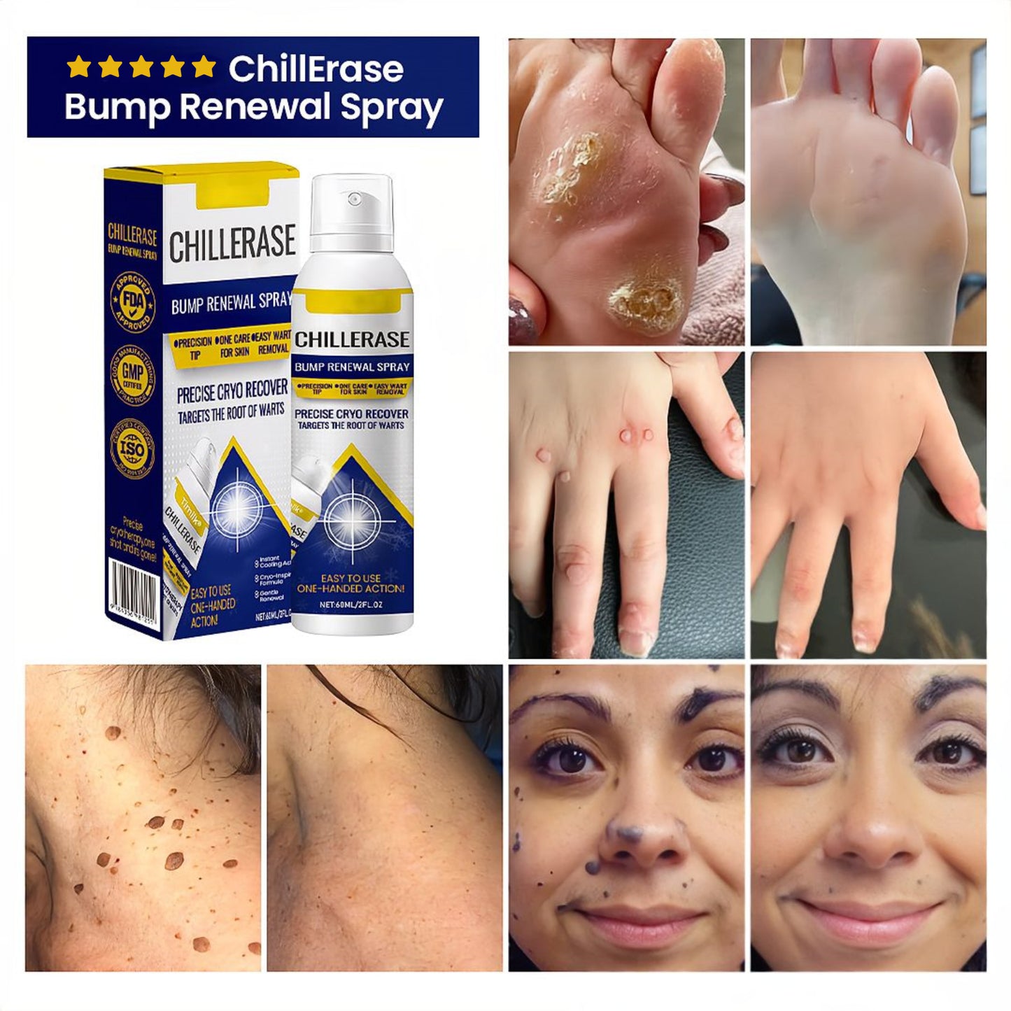 🏆 #1 Dermatologist-Recommended Cryo Renewal Spray🥼| Removes warts and skin tags efficiently while promoting your skin’s natural recovery🧪-8HJ9