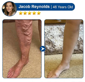 👨‍⚕️🔥 Vein Target Microneedle Care Patch⚡Instant Relief, Long-Term Results-8JX3