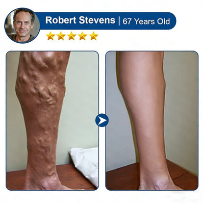 👨‍⚕️🔥 Vein Target Microneedle Care Patch⚡Instant Relief, Long-Term Results-8JX3