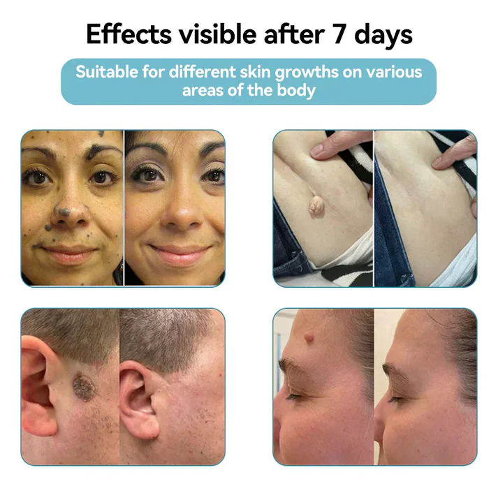 ✨ LIMITED TIME 50% OFF 💖All-in-One CO₂ Laser Eraser Pen | Removes Moles, Warts, Skin Flaws & Pigmentation-8YF7