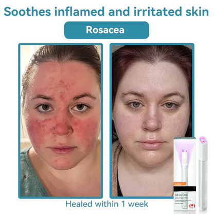 ✨ LIMITED TIME 50% OFF 💖All-in-One CO₂ Laser Eraser Pen | Removes Moles, Warts, Skin Flaws & Pigmentation-8YF7