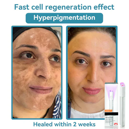 ✨ LIMITED TIME 50% OFF 💖All-in-One CO₂ Laser Eraser Pen | Removes Moles, Warts, Skin Flaws & Pigmentation-8YF7