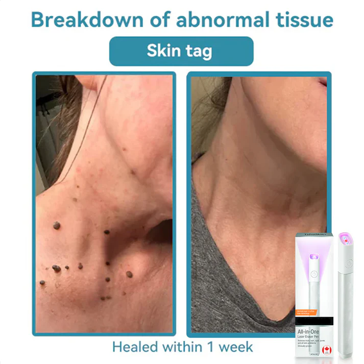✨ LIMITED TIME 50% OFF 💖All-in-One CO₂ Laser Eraser Pen | Removes Moles, Warts, Skin Flaws & Pigmentation-8YF7