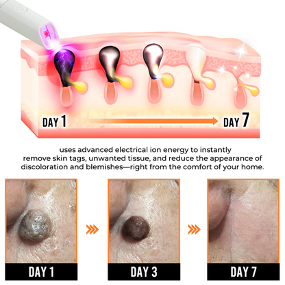 ✨ LIMITED TIME 50% OFF 💖All-in-One CO₂ Laser Eraser Pen | Removes Moles, Warts, Skin Flaws & Pigmentation-8YF7