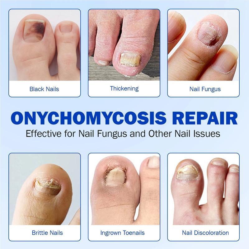 ✨LIMITED TIME 50% DISCOUNT✨ 21pcs Fungal Nail Care Patches Overnight Toenail Fungus Repair Strips for Damaged Discolored Nails-8YF7