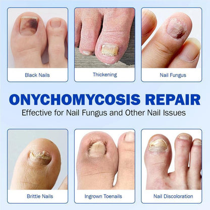 ✨LIMITED TIME 50% DISCOUNT✨ 21pcs Fungal Nail Care Patches Overnight Toenail Fungus Repair Strips for Damaged Discolored Nails-8YF7