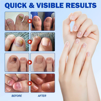 ✨LIMITED TIME 50% DISCOUNT✨ 21pcs Fungal Nail Care Patches Overnight Toenail Fungus Repair Strips for Damaged Discolored Nails-8YF7