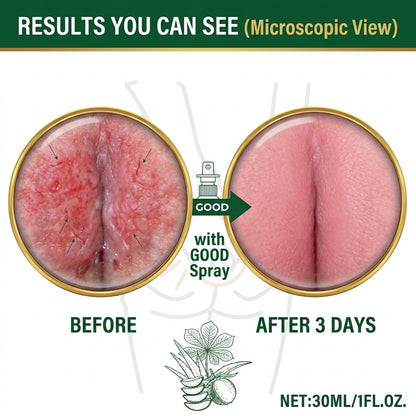 🔥50% OFF LIMITED TIME🩸Instant Hemorrhoid Relief Spray | Eliminate Itching, Burning & Painful Irritation Fast-8YF7