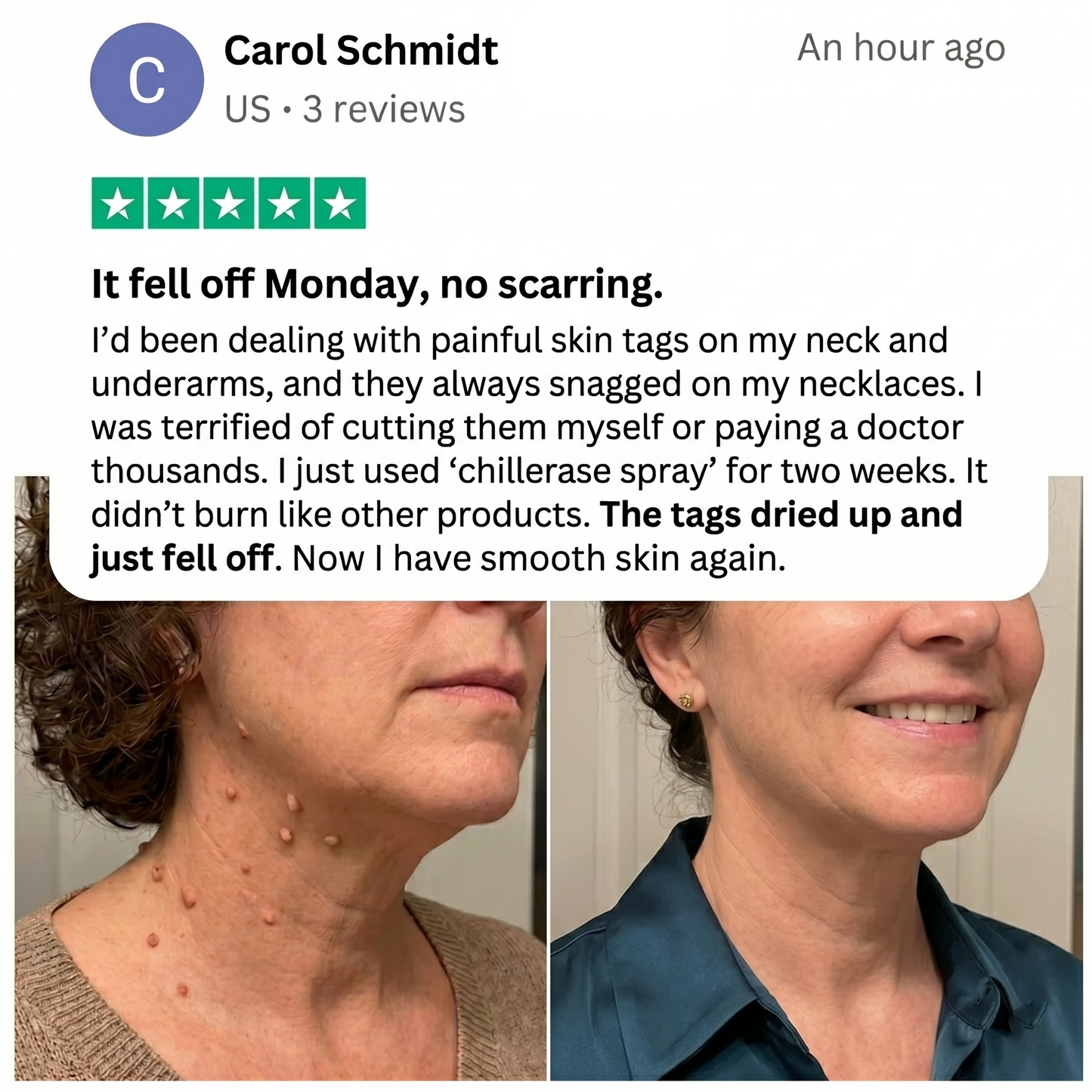 🏆 #1 Dermatologist-Recommended Cryo Renewal Spray🥼| Removes warts and skin tags efficiently while promoting your skin’s natural recovery🧪-8HJ9