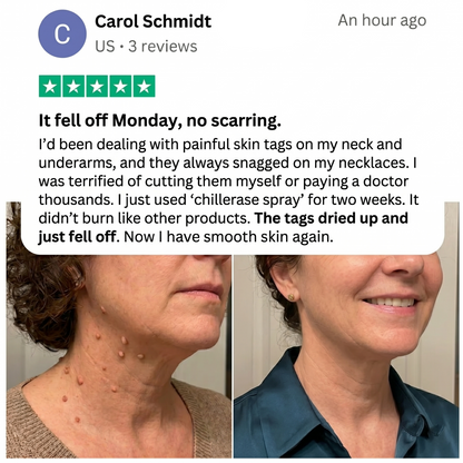 🏆 #1 Dermatologist-Recommended Cryo Renewal Spray🥼| Removes warts and skin tags efficiently while promoting your skin’s natural recovery🧪-8HJ9